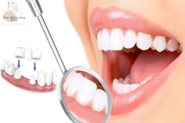 Bọc răng sứ là phương pháp nha khoa nhằm phục hình răng