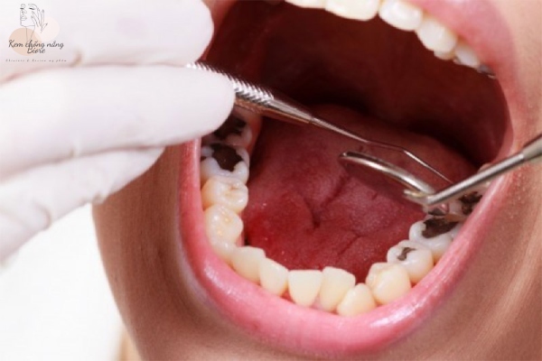 Việc lấy tủy được diễn ra khi răng bị hư hỏng nặng