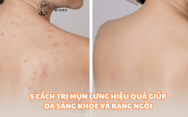 5 cách trị mụn lưng hiệu quả giúp da sáng khỏe và rạng ngời