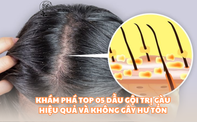 Khám Phá Top 05 Dầu Gội Trị Gàu Hiệu Quả Và Không Gây Hư Tổn